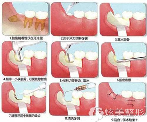 最新拔智齿技术，引领牙齿健康未来之路